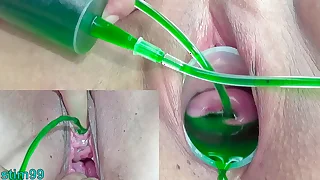 Cervix and Pee Fissure Inflation with Injections for Japanese Lesbians